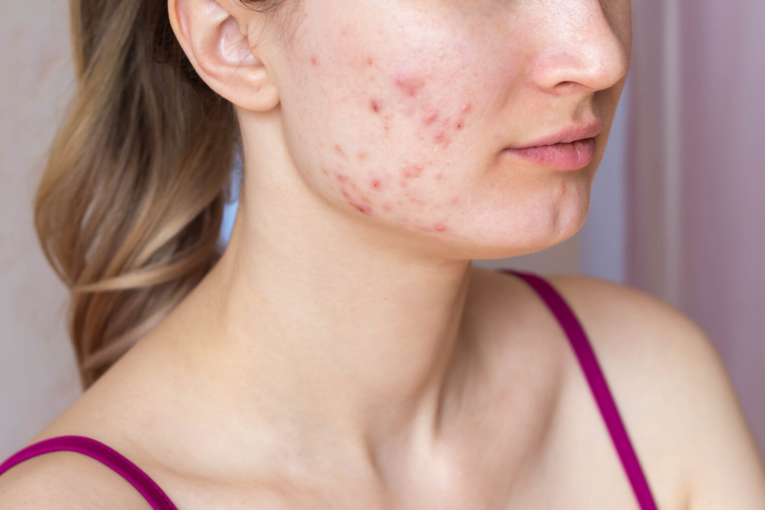 woman-face-problem-acne