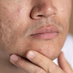 acne tet