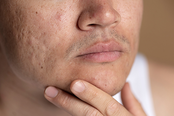 acne tet