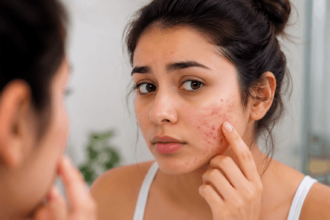 acne tips