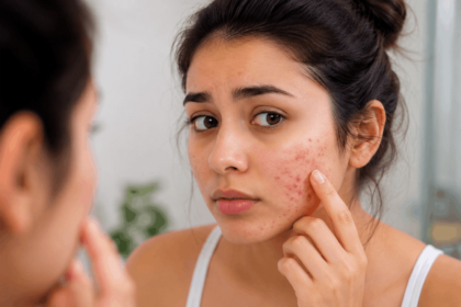 acne tips